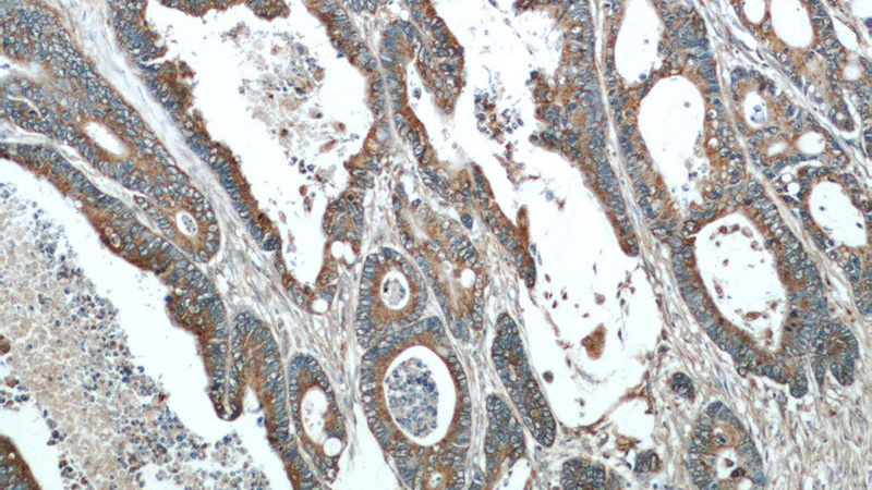 Immunohistochemical of paraffin-embedded human colon cancer using Catalog No:112119(KRAS antibody) at dilution of 1:50 (under 10x lens)