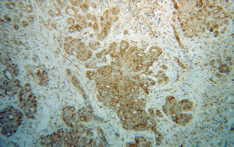 Immunohistochemical of paraffin-embedded human breast cancer using Catalog No:108839(CAPRIN1 antibody) at dilution of 1:100 (under 10x lens)