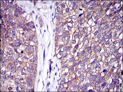 Immunohistochemical analysis of paraffin-embedded bladder cancer tissues using C-CBL mouse mAb with DAB staining.