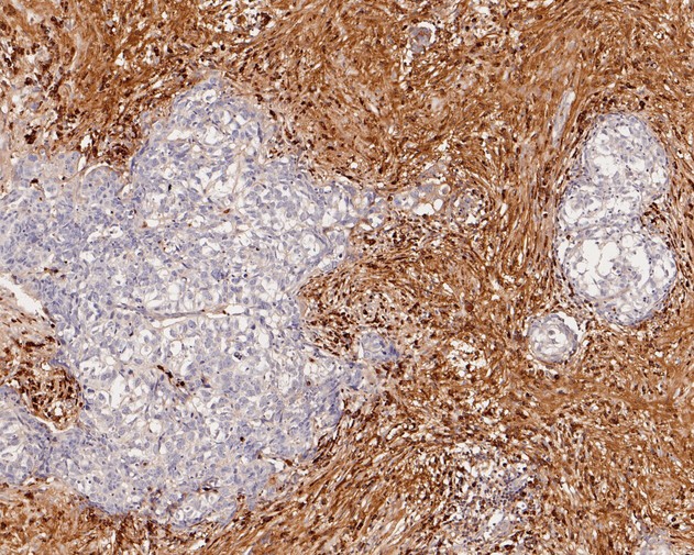 Fig3:; Immunohistochemical analysis of paraffin-embedded human breast carcinoma tissue using anti-Human Kappa light chain antibody. The section was pre-treated using heat mediated antigen retrieval with Tris-EDTA buffer (pH 8.0-8.4) for 20 minutes.The tissues were blocked in 5% BSA for 30 minutes at room temperature, washed with ddH; 2; O and PBS, and then probed with the primary antibody ( 1/50) for 30 minutes at room temperature. The detection was performed using an HRP conjugated compact polymer system. DAB was used as the chromogen. Tissues were counterstained with hematoxylin and mounted with DPX.