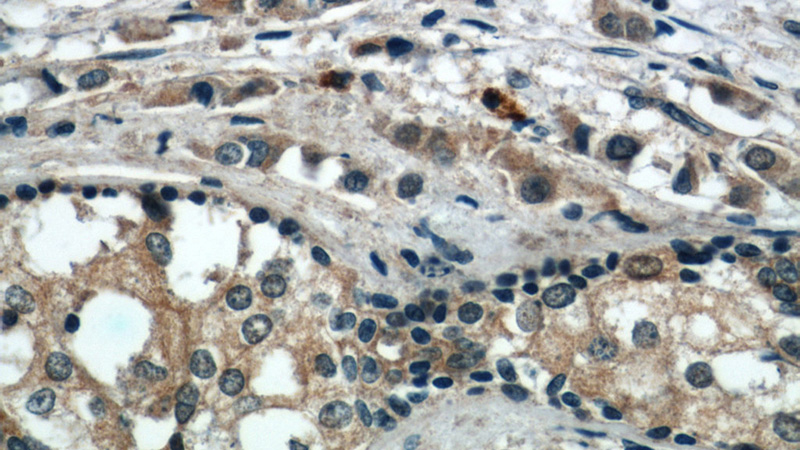 Immunohistochemical of paraffin-embedded human breast cancer using Catalog No:113556(SQSTM1 antibody) at dilution of 1:50 (under 40x lens)