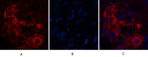 Immunofluorescence analysis of Human-lung-cancer tissue. 1,Carcinoembryonic Antigen Monoclonal Antibody(10E1)(red) was diluted at 1:200(4°C,overnight). 2, Cy3 labled Secondary antibody was diluted at 1:300(room temperature, 50min).3, Picture B: DAPI(blue) 10min. Picture A:Target. Picture B: DAPI. Picture C: merge of A+B