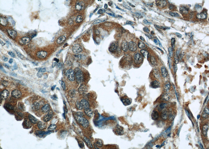 Immunohistochemical of paraffin-embedded human lung cancer using Catalog No:107606(STAT3 antibody) at dilution of 1:50 (under 40x lens)