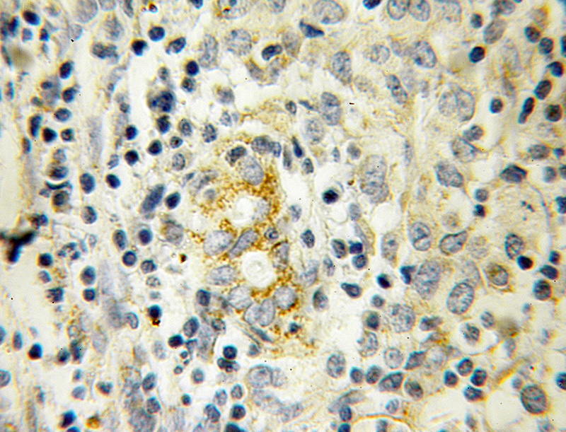 Immunohistochemical of paraffin-embedded human breast cancer using Catalog No:107925(AK3L1 antibody) at dilution of 1:100 (under 10x lens)