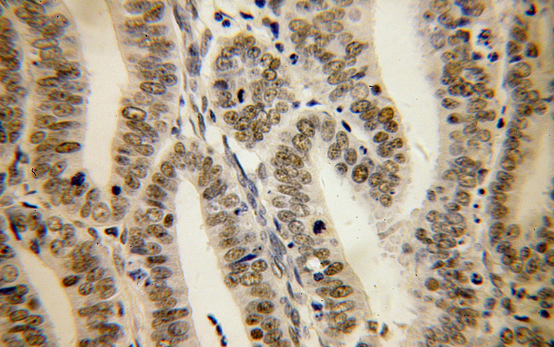 Immunohistochemical of paraffin-embedded human endometrial cancer using Catalog No:112503(MBD3 antibody) at dilution of 1:100 (under 40x lens)