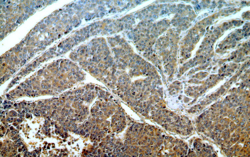 Immunohistochemical of paraffin-embedded human liver cancer using Catalog No:111068(GPNMB antibody) at dilution of 1:50 (under 10x lens)
