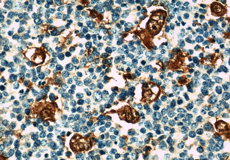 Immunohistochemical of paraffin-embedded human tonsillitis using Catalog No:114182(Pre-IL18 antibody) at dilution of 1:50 (under 40x lens)