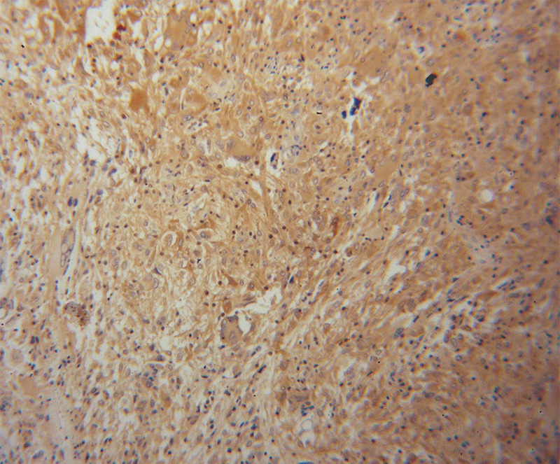 Immunohistochemical of paraffin-embedded human gliomas using Catalog No:112142(LAP3 antibody) at dilution of 1:50 (under 10x lens)
