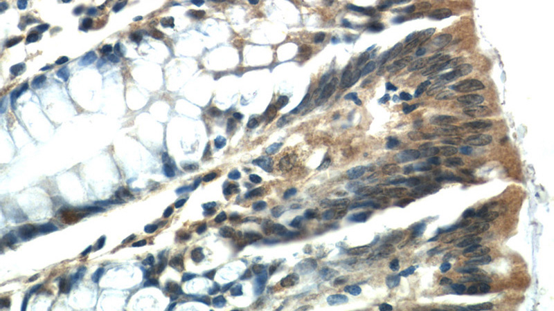 Immunohistochemistry of paraffin-embedded human colon tissue slide using Catalog No:111938(ISG20 Antibody) at dilution of 1:50 (under 40x lens)