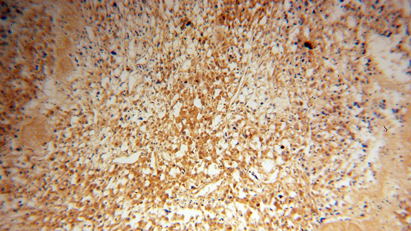 Immunohistochemical of paraffin-embedded human osteosarcoma using Catalog No:112781(MTM1 antibody) at dilution of 1:100 (under 10x lens)