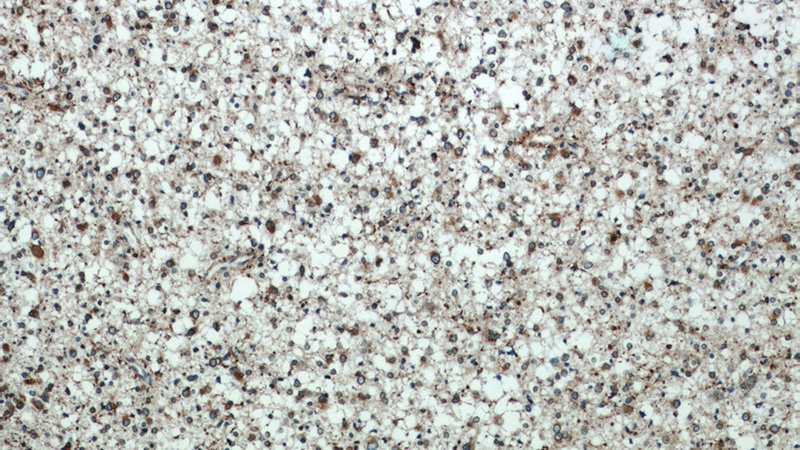 Immunohistochemical of paraffin-embedded human gliomas using Catalog No:112052(KIFAP3 antibody) at dilution of 1:50 (under 10x lens)