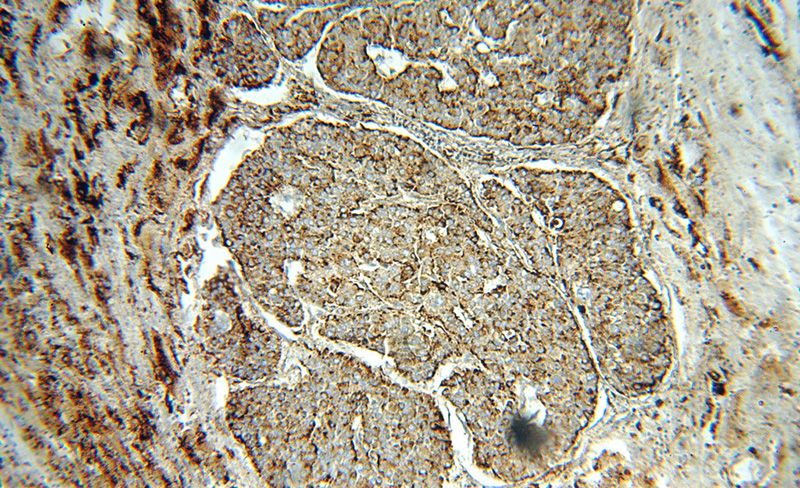 Immunohistochemical of paraffin-embedded human liver cancer using Catalog No:114288(PSAP antibody) at dilution of 1:50 (under 10x lens)