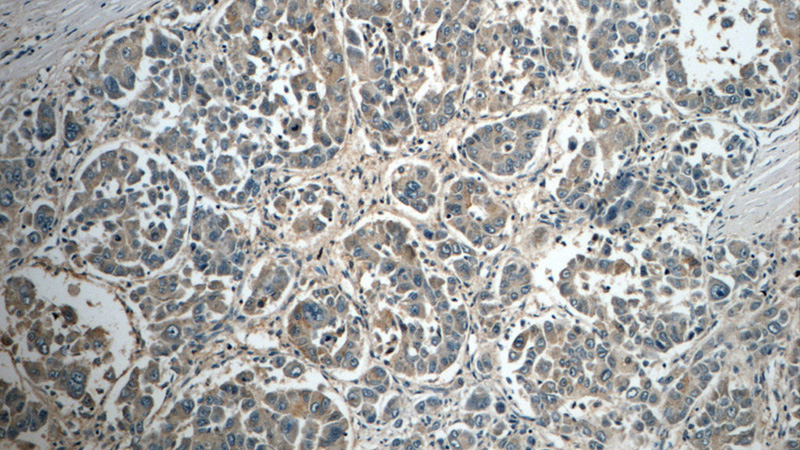 Immunohistochemistry of paraffin-embedded human liver cancer tissue slide using Catalog No:108765(CACNG1 Antibody) at dilution of 1:50 (under 10x lens)