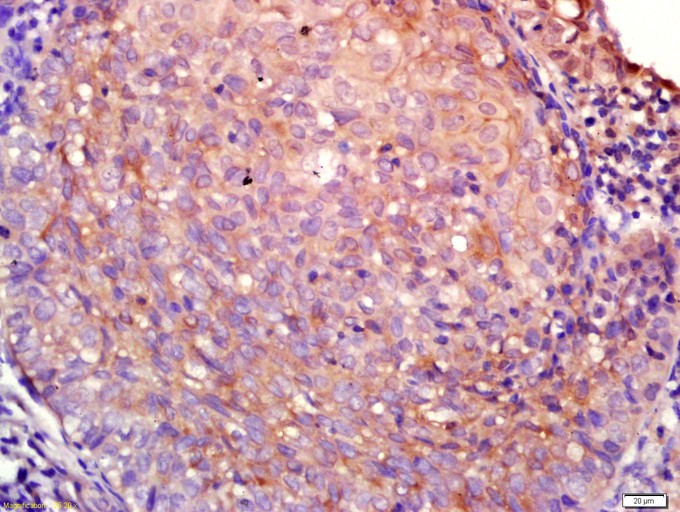 Fig1: Tissue/cell: human laryngocarcinoma; 4% Paraformaldehyde-fixed and paraffin-embedded;; Antigen retrieval: citrate buffer ( 0.01M, pH 6.0 ), Boiling bathing for 15min; Block endogenous peroxidase by 3% Hydrogen peroxide for 30min; Blocking buffer (normal goat serum,C-0005) at 37℃ for 20 min;; Incubation: Anti-AQP4 Polyclonal Antibody, Unconjugated 1:200, overnight at 4℃, followed by conjugation to the secondary antibody(SP-0023) and DAB(C-0010) staining