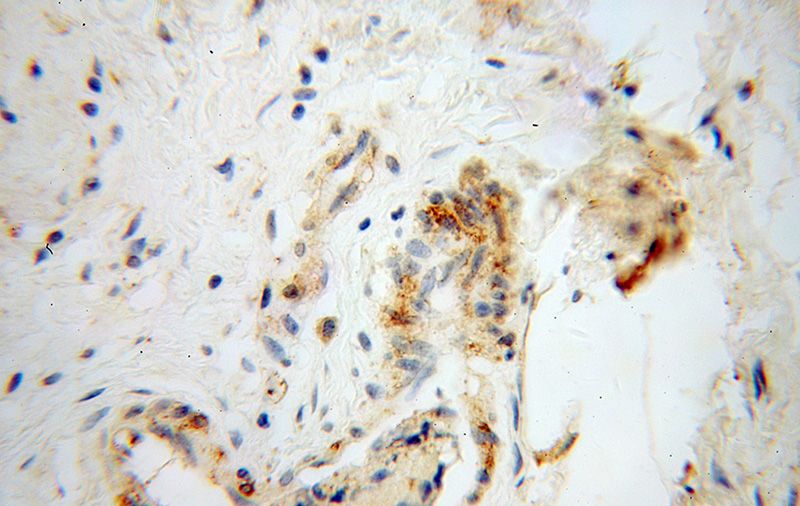 Immunohistochemical of paraffin-embedded human colon cancer using Catalog No:109884(DEFB1 antibody) at dilution of 1:100 (under 40x lens)