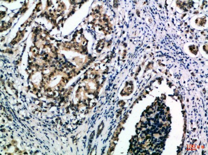 Fig1:; Immunohistochemical analysis of paraffin-embedded Human-breast-cancer, antibody was diluted at 1:100