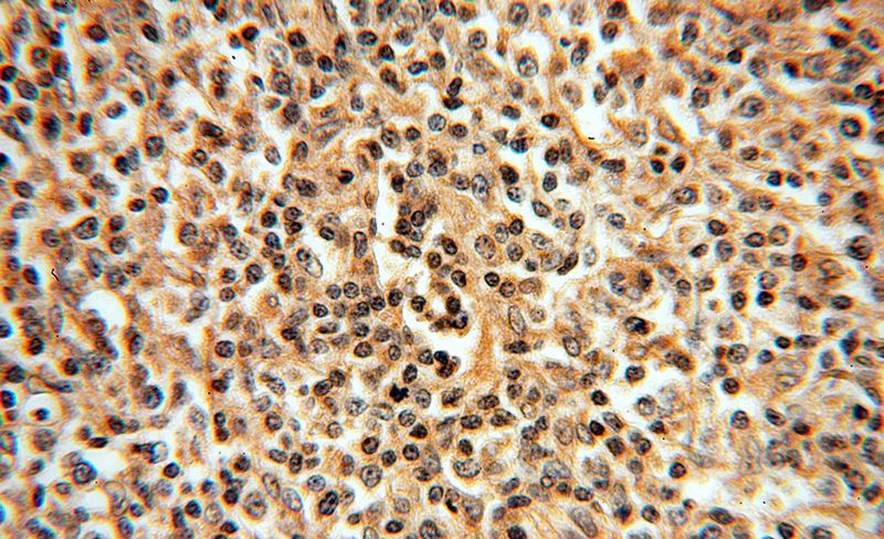 Immunohistochemical of paraffin-embedded human lymphoma using Catalog No:111841(IRF8 antibody) at dilution of 1:100 (under 40x lens)