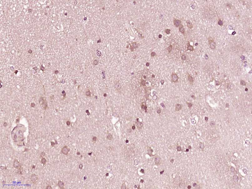 Fig1: Paraformaldehyde-fixed, paraffin embedded (Human brain glioma); Antigen retrieval by boiling in sodium citrate buffer (pH6.0) for 15min; Block endogenous peroxidase by 3% hydrogen peroxide for 20 minutes; Blocking buffer (normal goat serum) at 37℃ for 30min; Antibody incubation with (B7-H6) Polyclonal Antibody, Unconjugated at 1:400 overnight at 4℃, followed by operating according to SP Kit(Rabbit) (sp-0023) instructionsand DAB staining.