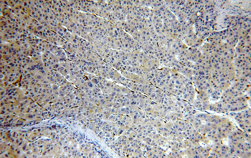 Immunohistochemical of paraffin-embedded human liver cancer using Catalog No:109786(CYGB antibody) at dilution of 1:100 (under 10x lens)