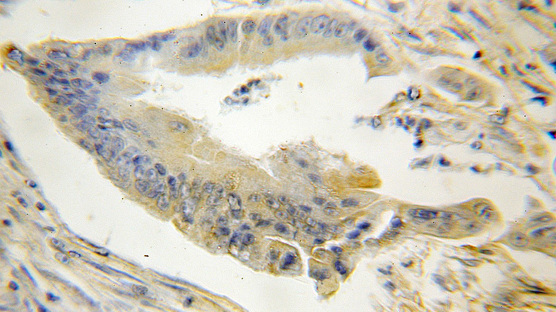 Immunohistochemical of paraffin-embedded human colon cancer using Catalog No:115727(STMN3 antibody) at dilution of 1:50 (under 10x lens)