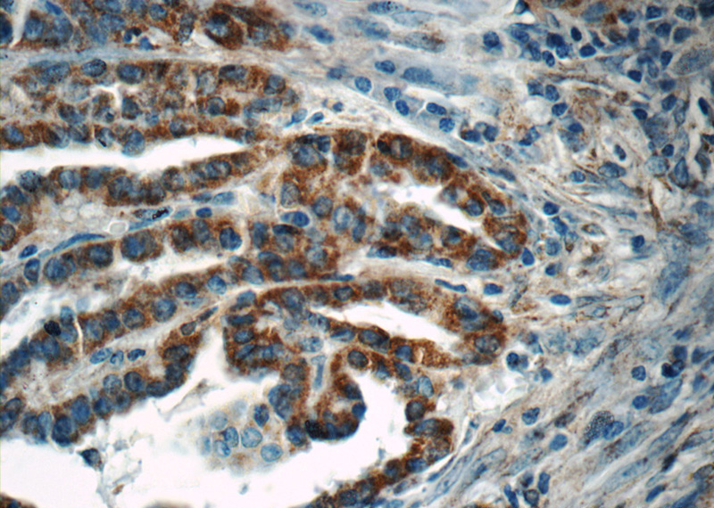 Immunohistochemistry of paraffin-embedded human thyroid cancer tissue slide using Catalog No:107823(ACAA1 Antibody) at dilution of 1:50 (under 40x lens)