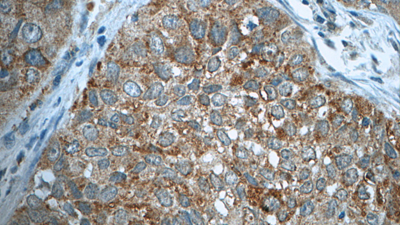 Immunohistochemistry of paraffin-embedded human lung cancer tissue slide using Catalog No:111834(IRF2BP2 Antibody) at dilution of 1:50