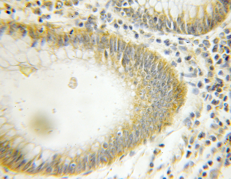 Immunohistochemical of paraffin-embedded human colon cancer using Catalog No:108289(ATG12 antibody) at dilution of 1:10 (under 10x lens)