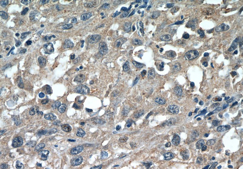 Immunohistochemistry of paraffin-embedded human cervical cancer tissue slide using Catalog No:109114(CDCA3 Antibody) at dilution of 1:50 (under 40x lens)