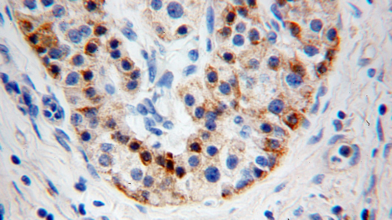 Immunohistochemical of paraffin-embedded human pancreas cancer using Catalog No:110305(EDIL3 antibody) at dilution of 1:100 (under 40x lens)