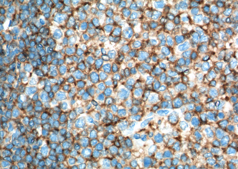 Immunohistochemistry of paraffin-embedded human tonsillitis tissue slide using Catalog No:107137(CD45 Antibody) at dilution of 1:300 (under 40x lens). heat mediated antigen retrieved with Tris-EDTA buffer(pH9).