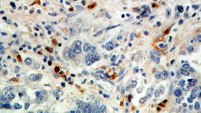 Immunohistochemical of paraffin-embedded human stomach cancer using Catalog No:114965(S100A8 antibody) at dilution of 1:100 (under 40x lens)