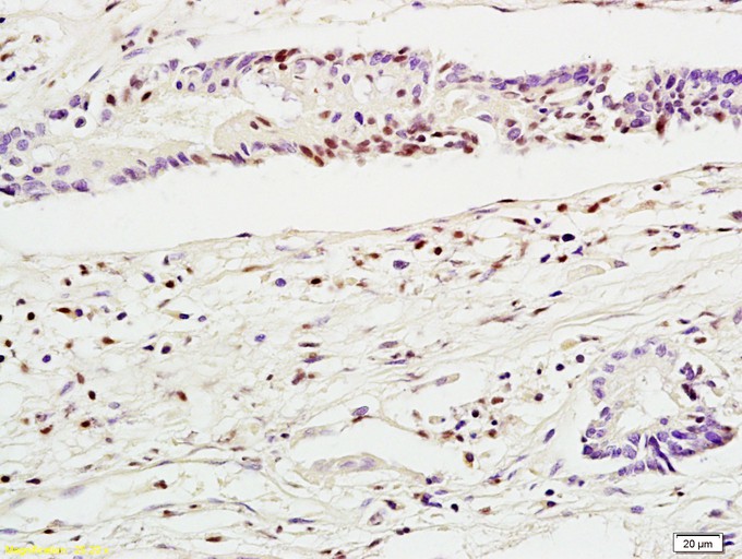 Fig1: Tissue/cell: human colon carcinoma; 4% Paraformaldehyde-fixed and paraffin-embedded;; Antigen retrieval: citrate buffer ( 0.01M, pH 6.0 ), Boiling bathing for 15min; Block endogenous peroxidase by 3% Hydrogen peroxide for 30min; Blocking buffer (normal goat serum,C-0005) at 37℃ for 20 min;; Incubation: Anti-Mel18/ZNF144 Polyclonal Antibody, Unconjugated 1:200, overnight at 4℃, followed by conjugation to the secondary antibody(SP-0023) and DAB(C-0010) staining