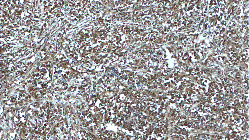 Immunohistochemistry of paraffin-embedded human lymphoma tissue slide using Catalog No:117102(BCL6 Antibody) at dilution of 1:400 (under 10x lens). heat mediated antigen retrieved with Sodium Citrate buffer (pH6).