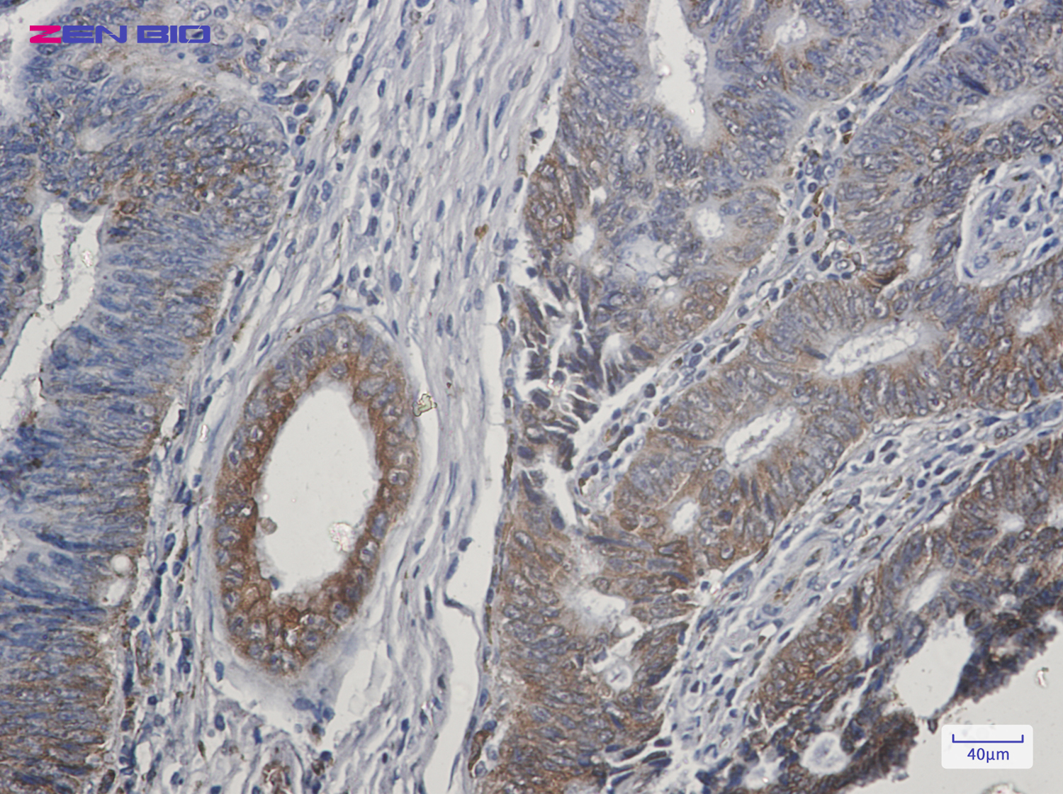 Immunohistochemistry of TGF alpha in paraffin-embedded Human colon cancer tissue using TGF alpha Rabbit pAb at dilution 1/50