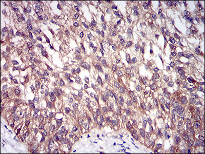 Fig5: Immunohistochemical analysis of paraffin-embedded human bladder cancer tissue using anti-DIS3L2 antibody. Counter stained with hematoxylin.
