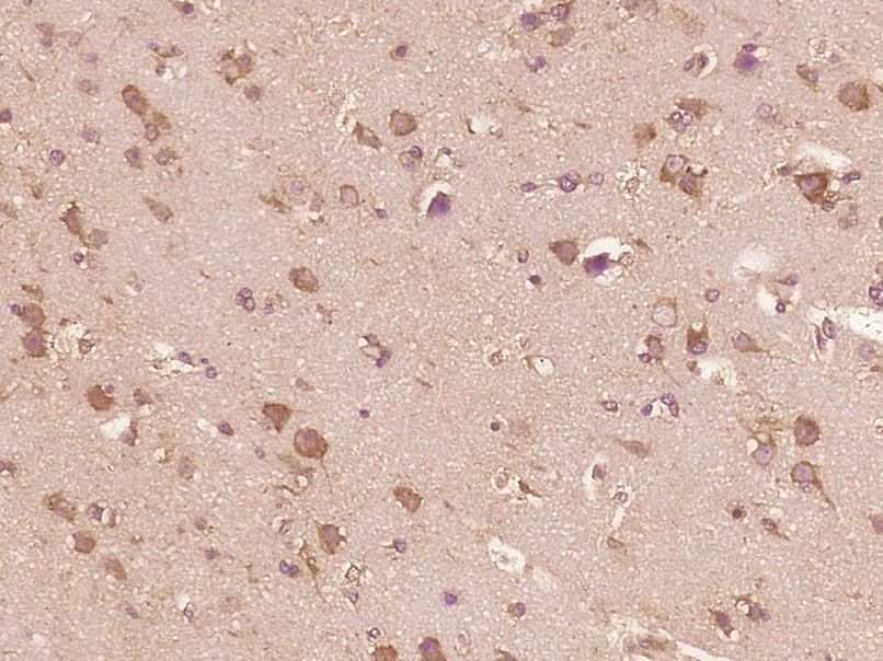 Fig4: Paraformaldehyde-fixed, paraffin embedded (Human brain glioma); Antigen retrieval by boiling in sodium citrate buffer (pH6.0) for 15min; Block endogenous peroxidase by 3% hydrogen peroxide for 20 minutes; Blocking buffer (normal goat serum) at 37℃ for 30min; Antibody incubation with (IL-13) Polyclonal Antibody, Unconjugated at 1:400 overnight at 4℃, followed by operating according to SP Kit(Rabbit) (sp-0023) instructionsand DAB staining.