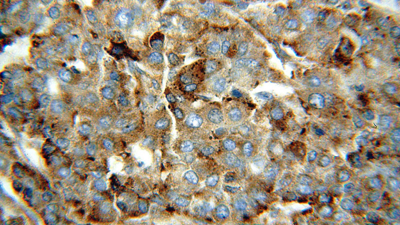 Immunohistochemical of paraffin-embedded human liver cancer using Catalog No:114288(PSAP antibody) at dilution of 1:50 (under 40x lens)