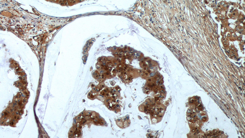 Immunohistochemistry of paraffin-embedded human breast cancer tissue slide using Catalog No:116507(UBE2N Antibody) at dilution of 1:200 (under 10x lens)