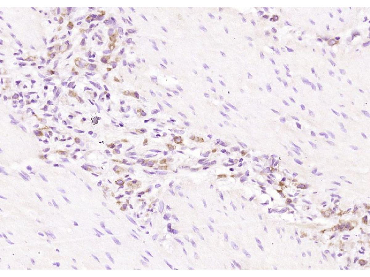 Fig5: Paraformaldehyde-fixed, paraffin embedded (human gastric carcinoma); Antigen retrieval by boiling in sodium citrate buffer (pH6.0) for 15min; Block endogenous peroxidase by 3% hydrogen peroxide for 20 minutes; Blocking buffer (normal goat serum) at 37℃ for 30min; Antibody incubation with (Pan Cytokeratin) Polyclonal Antibody, Unconjugated at 1:200 overnight at 4℃, followed by operating according to SP Kit(Rabbit) (sp-0023) instructionsand DAB staining.