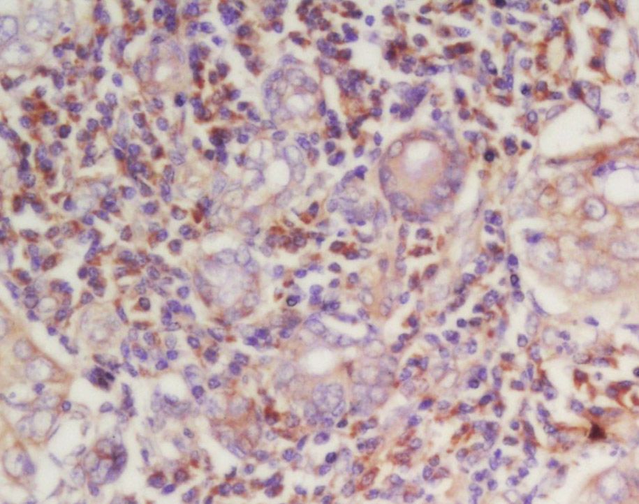 Fig2: Tissue/cell: human laryngocarcinoma; 4% Paraformaldehyde-fixed and paraffin-embedded;; Antigen retrieval: citrate buffer ( 0.01M, pH 6.0 ), Boiling bathing for 15min; Block endogenous peroxidase by 3% Hydrogen peroxide for 30min; Blocking buffer (normal goat serum,C-0005) at 37℃ for 20 min;; Incubation: Anti-Cyclin-E Polyclonal Antibody, Unconjugated 1:200, overnight at 4℃, followed by conjugation to the secondary antibody(SP-0023) and DAB(C-0010) staining