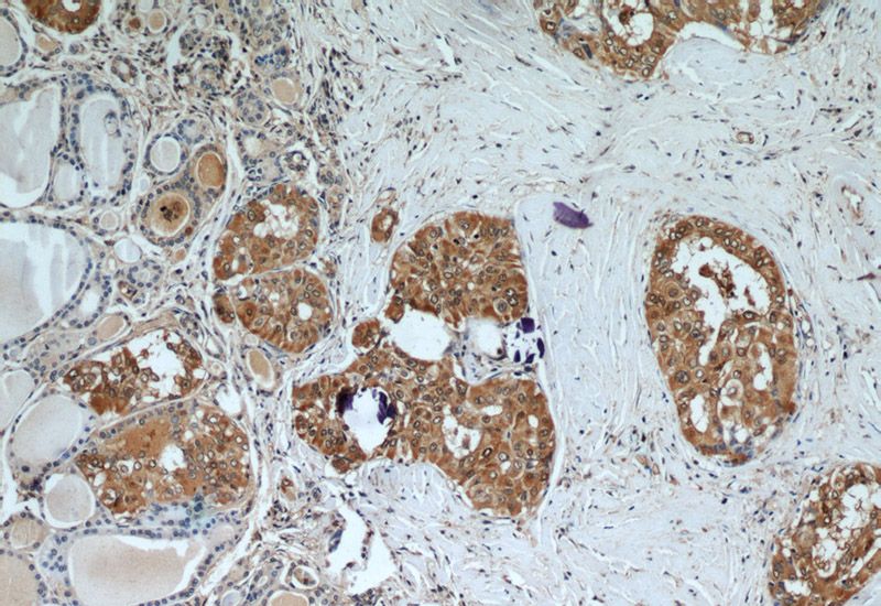 Immunohistochemical of paraffin-embedded human thyroid cancer using Catalog No:110840(Galectin 3 antibody) at dilution of 1:50 (under 10x lens)