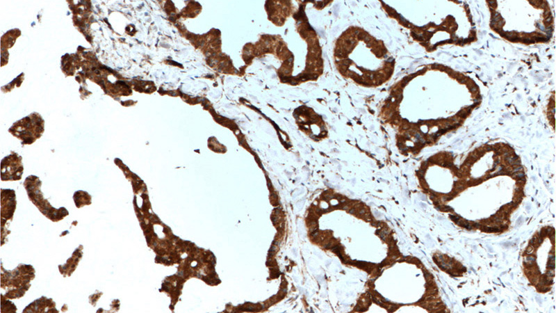 Immunohistochemistry of paraffin-embedded human breast cancer tissue slide using Catalog No:115827(SULT1A4 Antibody) at dilution of 1:200 (under 10x lens). heat mediated antigen retrieved with Tris-EDTA buffer(pH9).