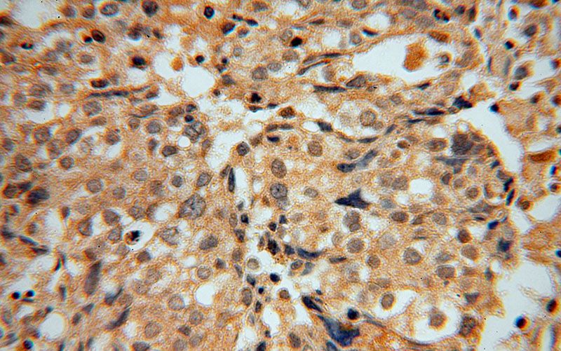 Immunohistochemical of paraffin-embedded human ovary tumor using Catalog No:113683(PCBD1 antibody) at dilution of 1:50 (under 40x lens)
