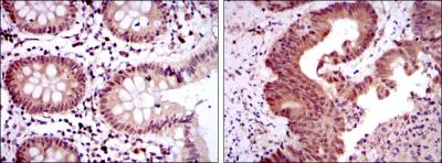 Immunohistochemical analysis of paraffin-embedded colon tissues (left) and colon cancer tissues (right) using OTX2 mouse mAb with DAB staining.