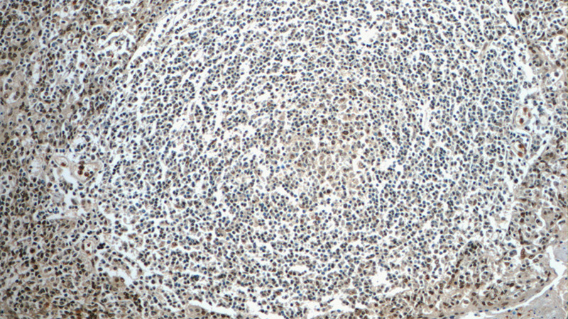 Immunohistochemistry of paraffin-embedded human tonsillitis tissue slide using Catalog No:113018(NLRP1 Antibody) at dilution of 1:50 (under 10x lens)