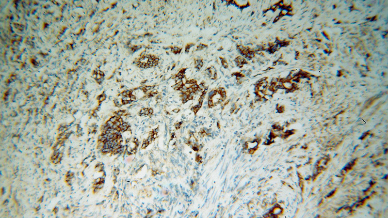 Immunohistochemical of paraffin-embedded human gliomas using Catalog No:112662(IMMT antibody) at dilution of 1:100 (under 10x lens)