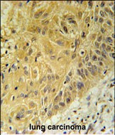 WNT5A Antibody (Center) immunohistochemistry analysis in formalin fixed and paraffin embedded human lung carcinoma followed by peroxidase conjugation of the secondary antibody and DAB staining. This data demonstrates the use of the WNT5A Antibody (Center) for immunohistochemistry. Clinical relevance has not been evaluated.