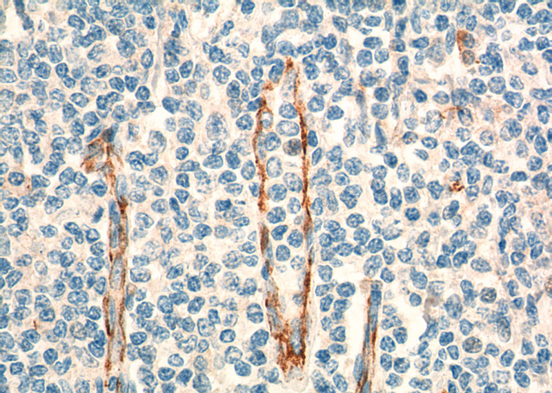 Immunohistochemistry of paraffin-embedded human tonsillitis tissue slide using Catalog No:107131(CD31 Antibody) at dilution of 1:400 (under 40x lens). Heat mediated antigen retrieved with Tris-EDTA buffer, pH9.0