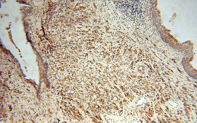 Immunohistochemical of paraffin-embedded human prostate cancer using Catalog No:107899(AEG-1 antibody) at dilution of 1:100 (under 10x lens)