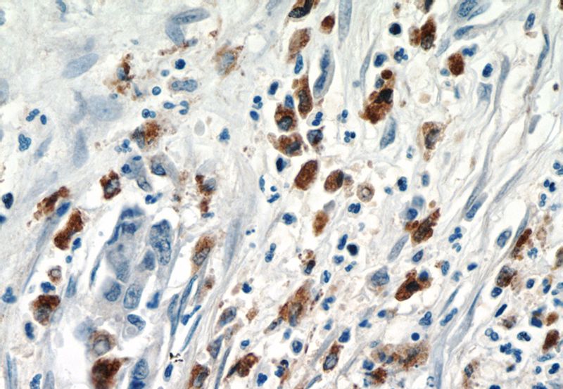 Immunohistochemistry of paraffin-embedded human pancreas cancer tissue slide using Catalog No:111937(ISG15 Antibody) at dilution of 1:50 (under 40x lens)